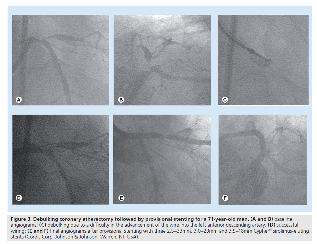 interventional-cardiology-Debulking