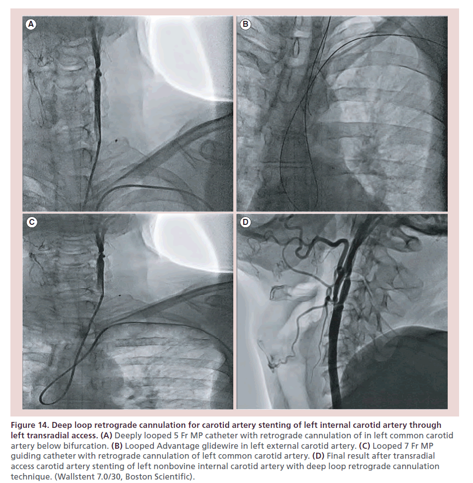 interventional-cardiology-Deep-loop-retrograde