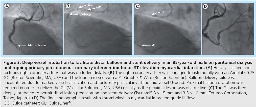 interventional-cardiology-Deep-vessel-intubation