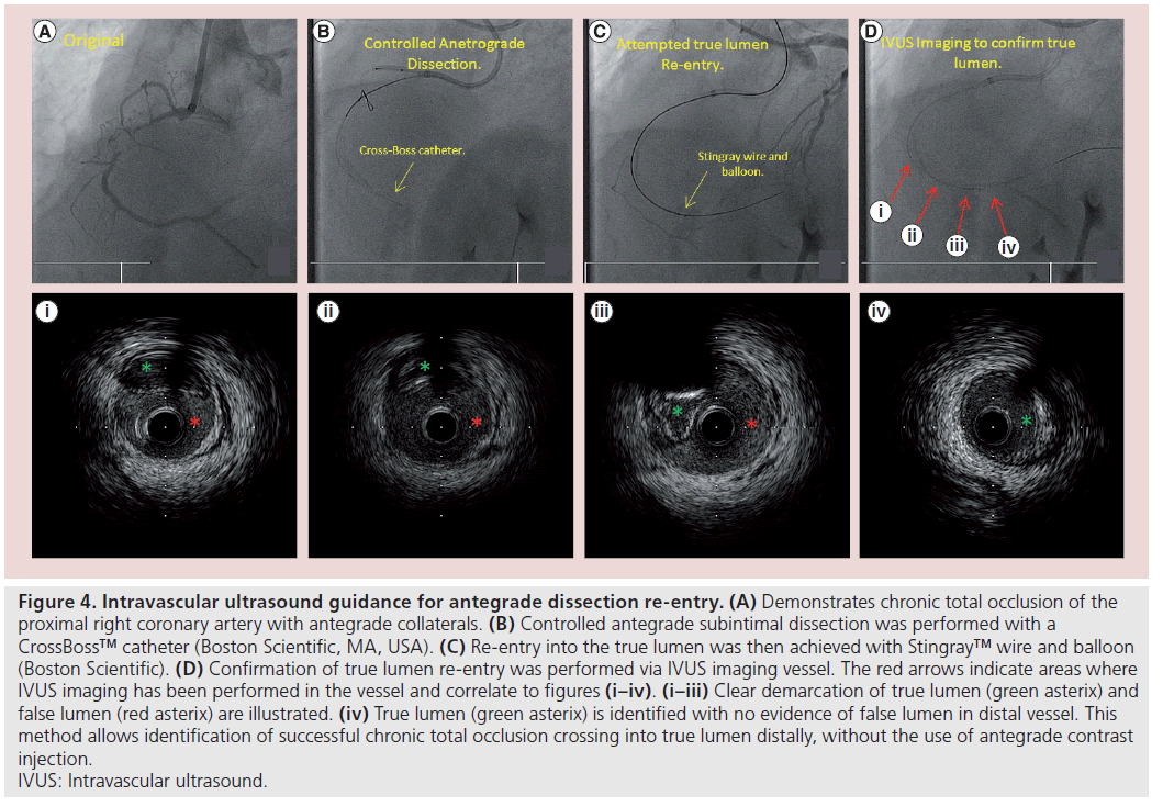 interventional-cardiology-Demonstrates-chronic