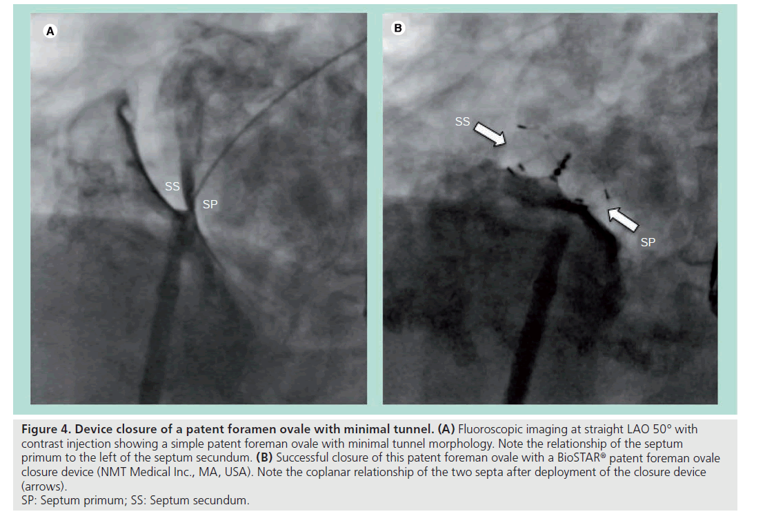 interventional-cardiology-Device-closure