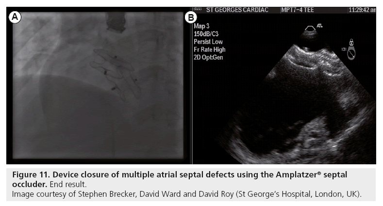 interventional-cardiology-Device-closure