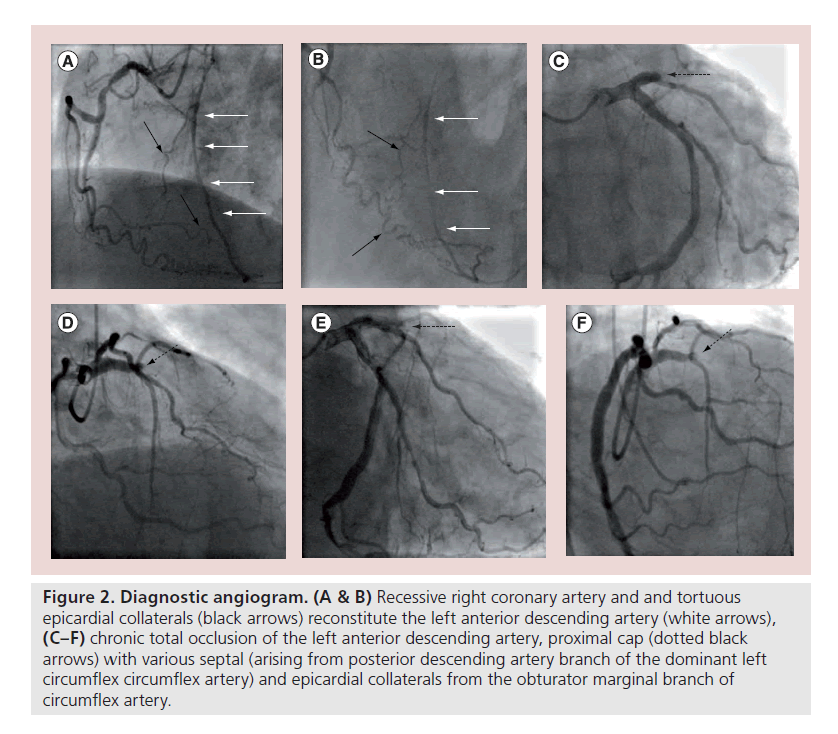 interventional-cardiology-Diagnostic-angiogram