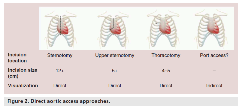 interventional-cardiology-Direct-aortic