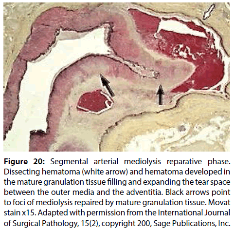 interventional-cardiology-Dissecting-hematoma