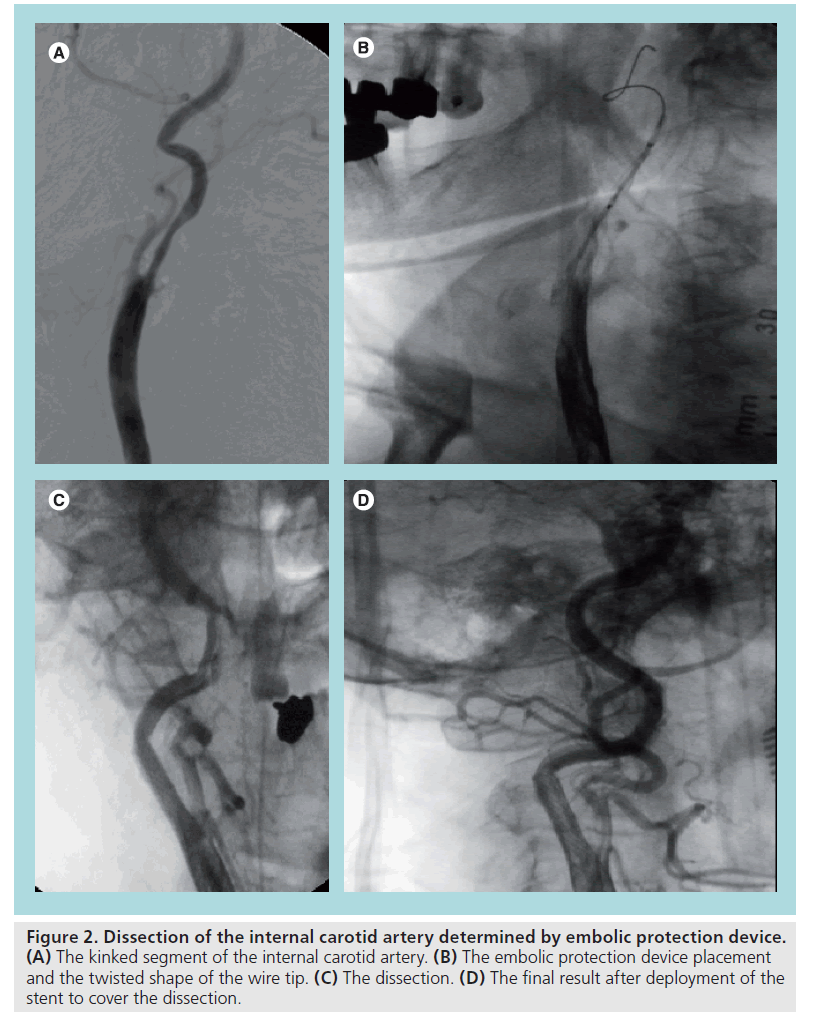 interventional-cardiology-Dissection-internal