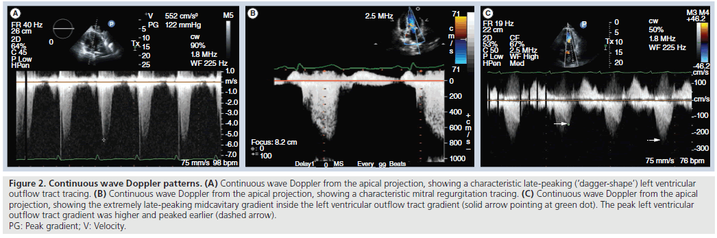 interventional-cardiology-Doppler