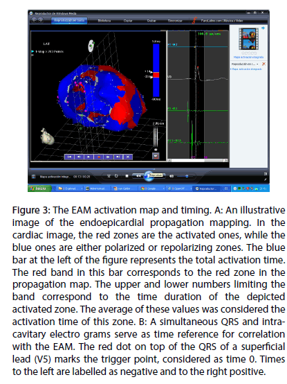 interventional-cardiology-EAM-activation