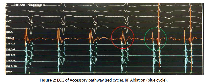 interventional-cardiology-ECG-Accessory