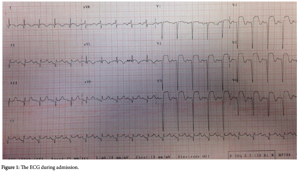 interventional-cardiology-ECG-during-admission