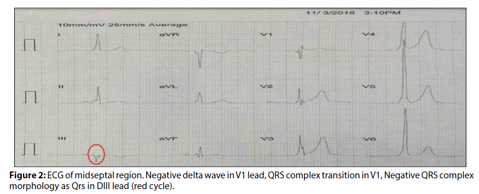 interventional-cardiology-ECG-midseptal