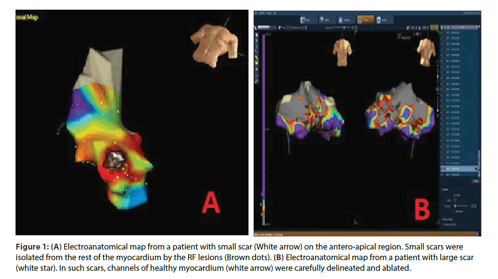 interventional-cardiology-Electroanatomical-map-patient