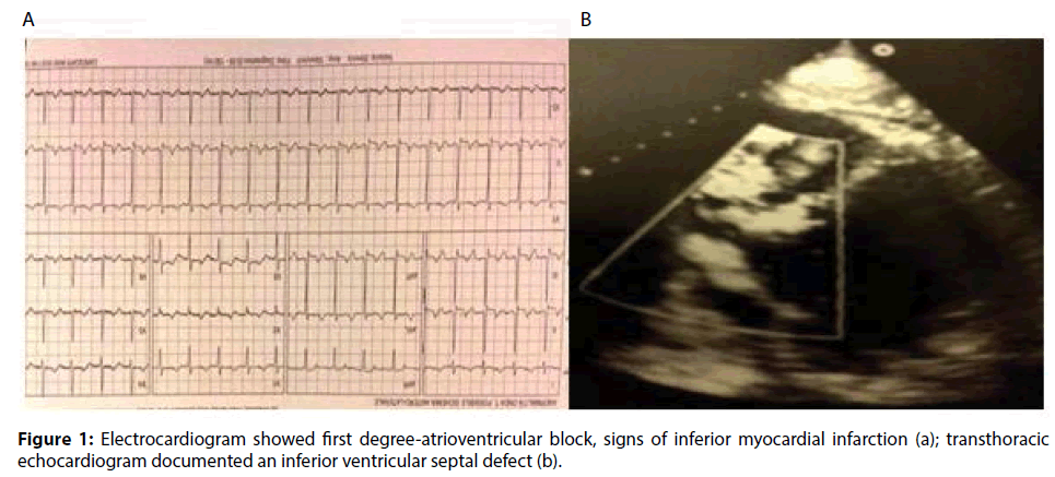 interventional-cardiology-Electrocardiogram-first