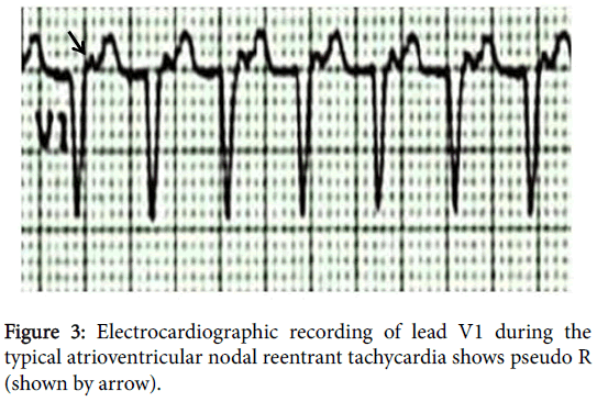 interventional-cardiology-Electrocardiographic-recording