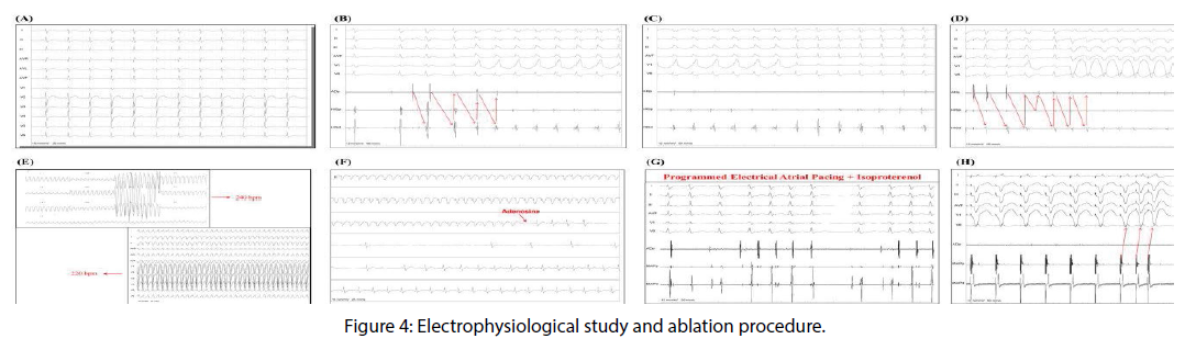 interventional-cardiology-Electrophysiological-study