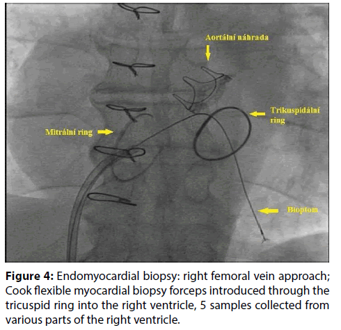 interventional-cardiology-Endomyocardial-biopsy