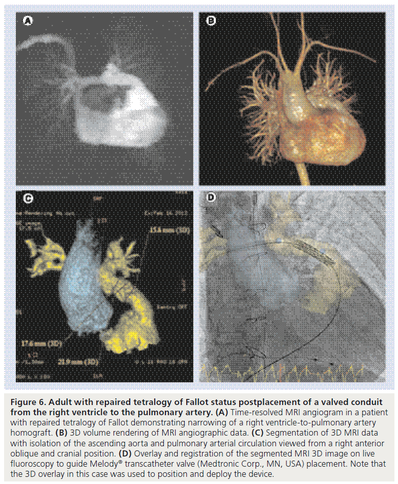 interventional-cardiology-Fallot-status-postplacement