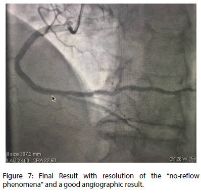 interventional-cardiology-Final-Result