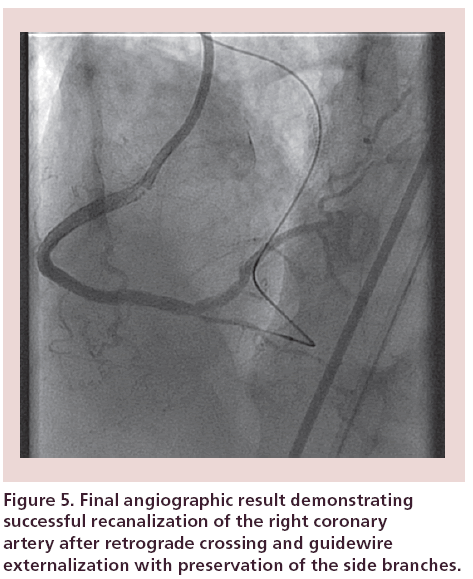 interventional-cardiology-Final-angiographic-result
