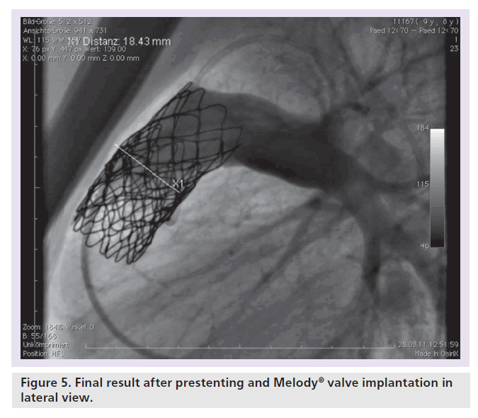 interventional-cardiology-Final-result