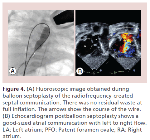 interventional-cardiology-Fluoroscopic-image-balloon