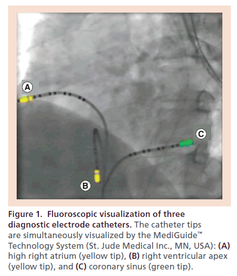 interventional-cardiology-Fluoroscopic-visualization
