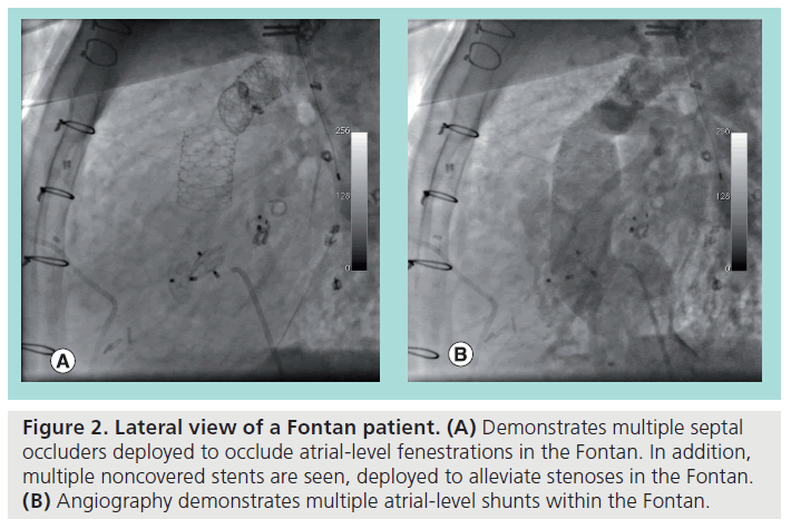 interventional-cardiology-Fontan-patient