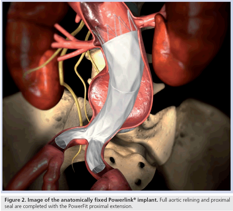 interventional-cardiology-Full-aortic-relining
