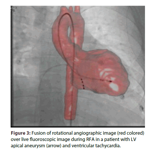 interventional-cardiology-Fusion-rotational-angiographic