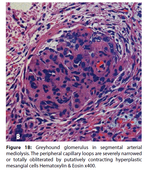 interventional-cardiology-Greyhound-glomerulus