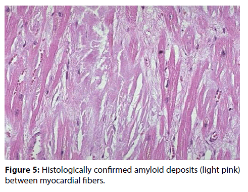 interventional-cardiology-Histologically-confirmed