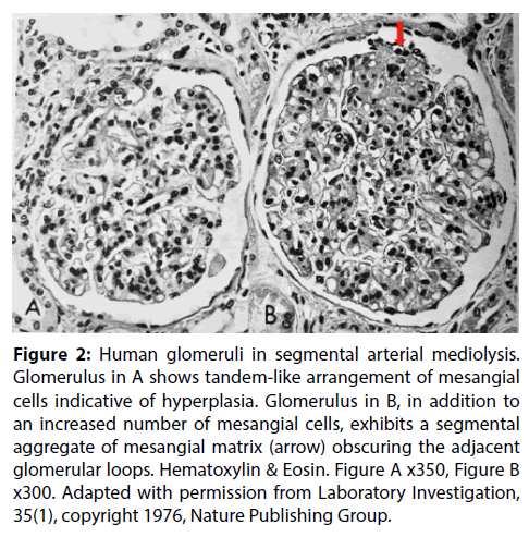 interventional-cardiology-Human-glomeruli