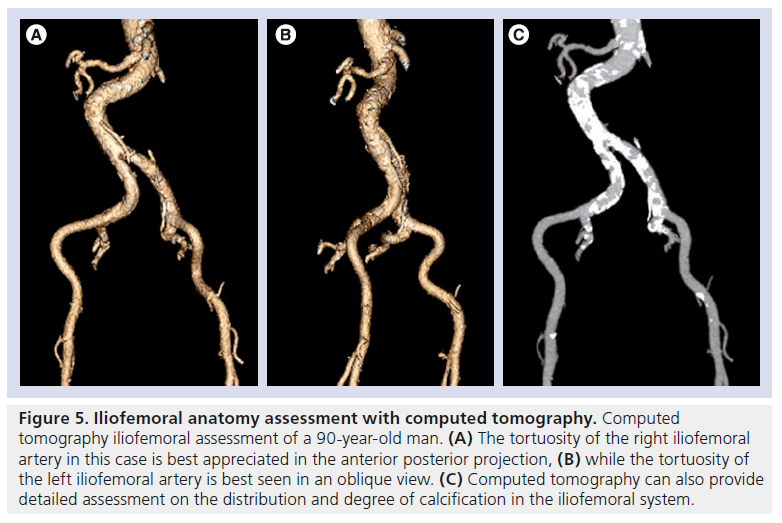 interventional-cardiology-Iliofemoral-anatomy