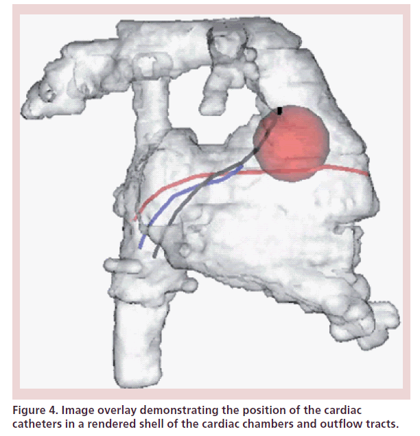 interventional-cardiology-Image-overlay