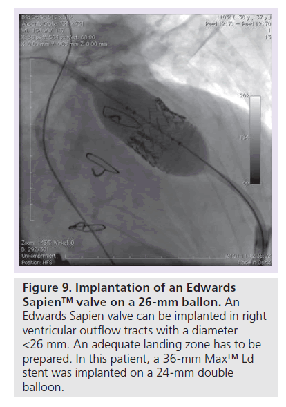 interventional-cardiology-Implantation