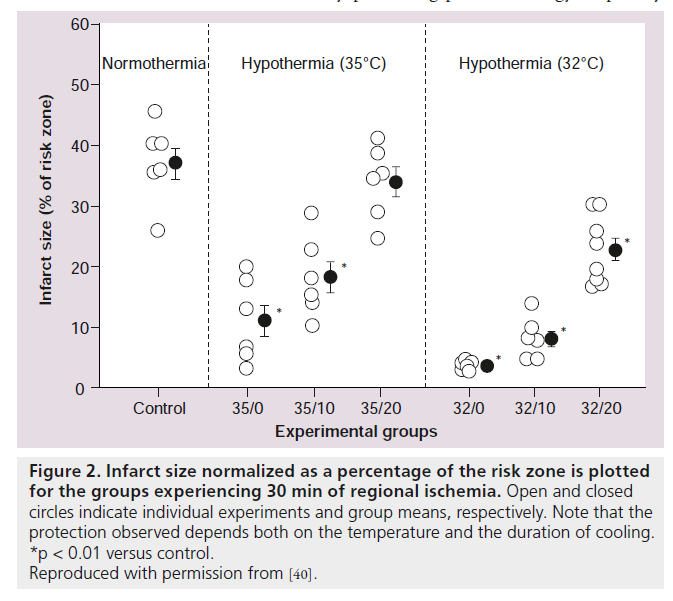 interventional-cardiology-Infarct-size