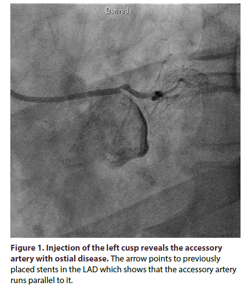interventional-cardiology-Injection-left