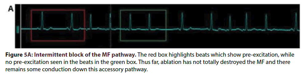 interventional-cardiology-Intermittent-block
