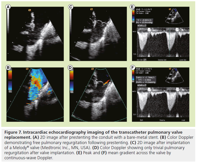interventional-cardiology-Intracardiac-echocardiography