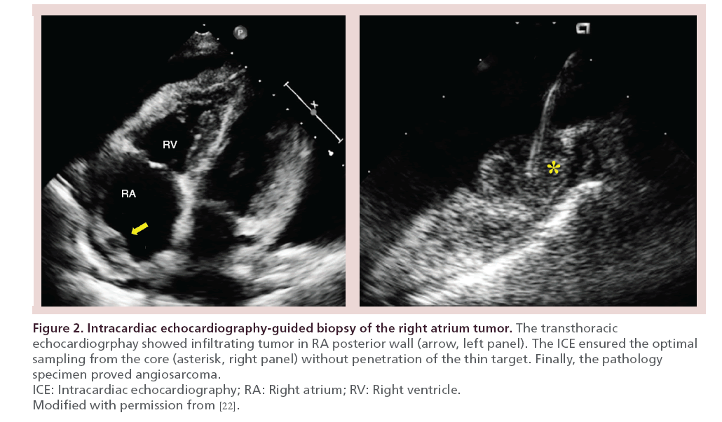 interventional-cardiology-Intracardiac-echocardiography