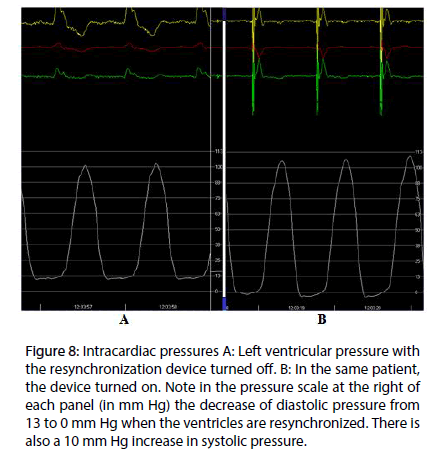 interventional-cardiology-Intracardiac-pressures