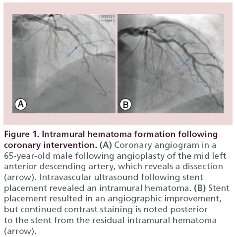 interventional-cardiology-Intramural-hematoma-formation