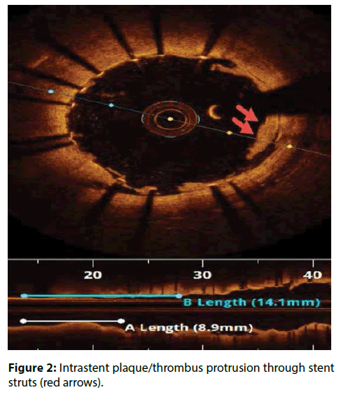 interventional-cardiology-Intrastent-plaque