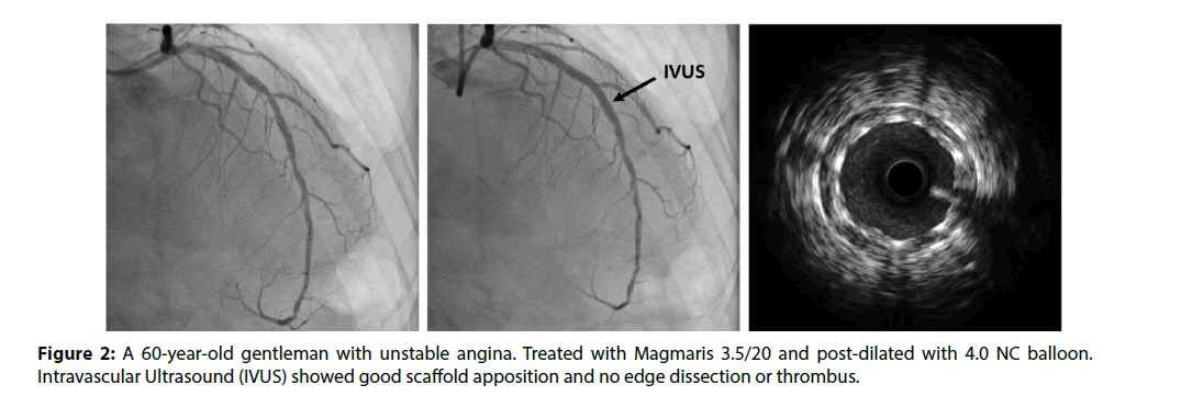 interventional-cardiology-Intravascular-Ultrasound