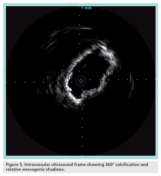 interventional-cardiology-Intravascular-ultrasound