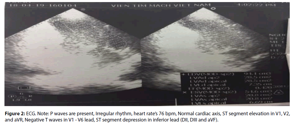 interventional-cardiology-Irregular-rhythm