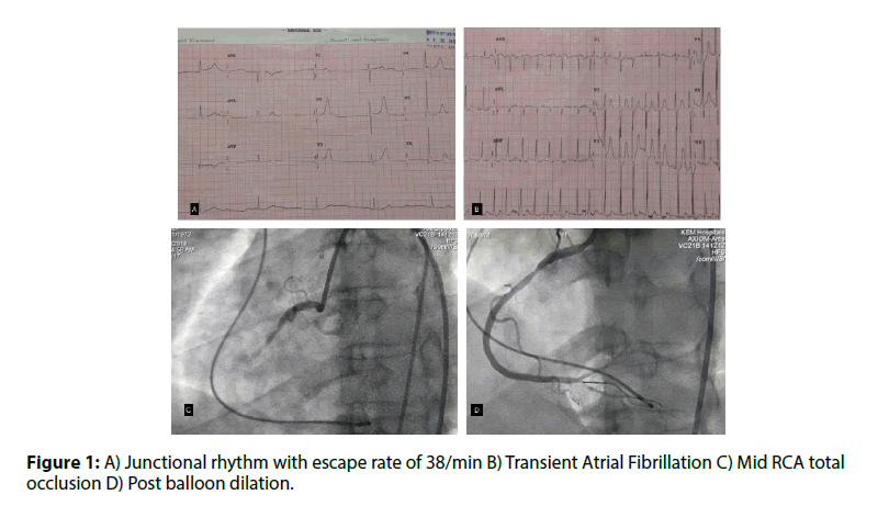interventional-cardiology-Junctional-rhythm