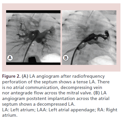 interventional-cardiology-LA-angiogram-radiofrequency