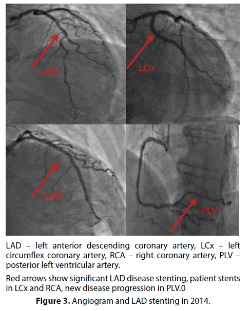 interventional-cardiology-LAD-stenting