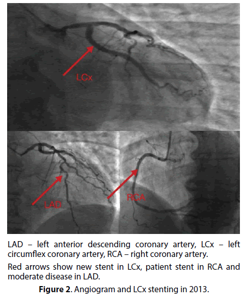 interventional-cardiology-LCx-stenting